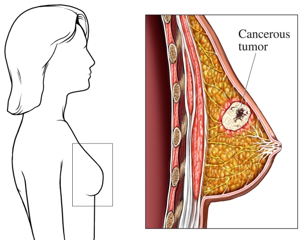 Breast Cancer Causes Risk Factors and Prevalence